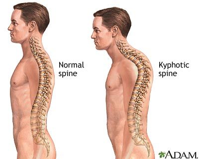 rounded shoulders